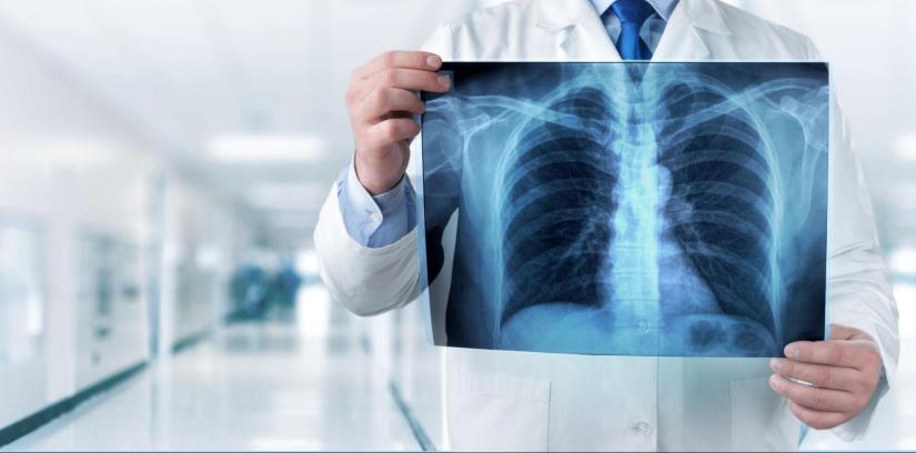   Advanced Lung Cancer Surgery and Treatment Options at Geetanjali Hospital, Udaipur